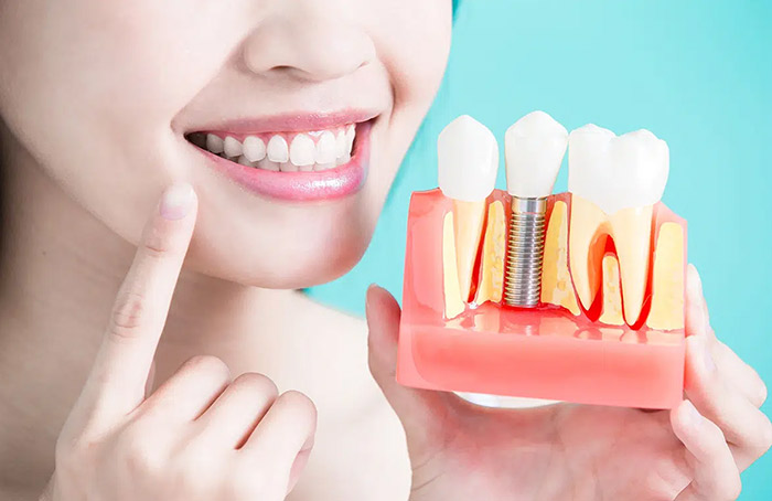 Dental Implants
