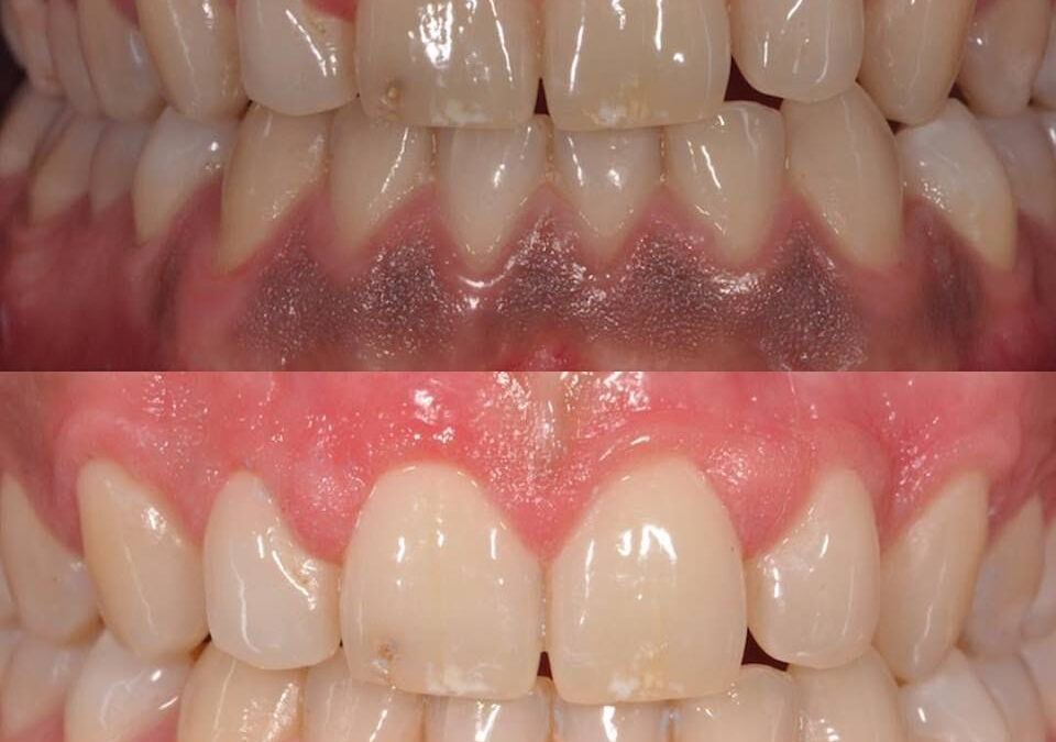 Gum Bleaching