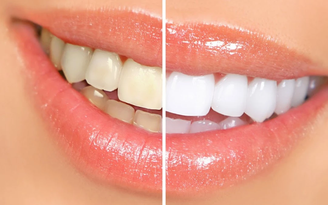 dental-bleaching-Art-Dent