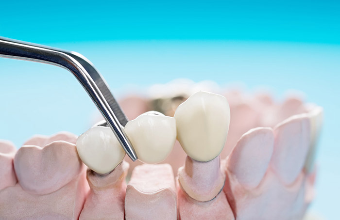 dental bridges