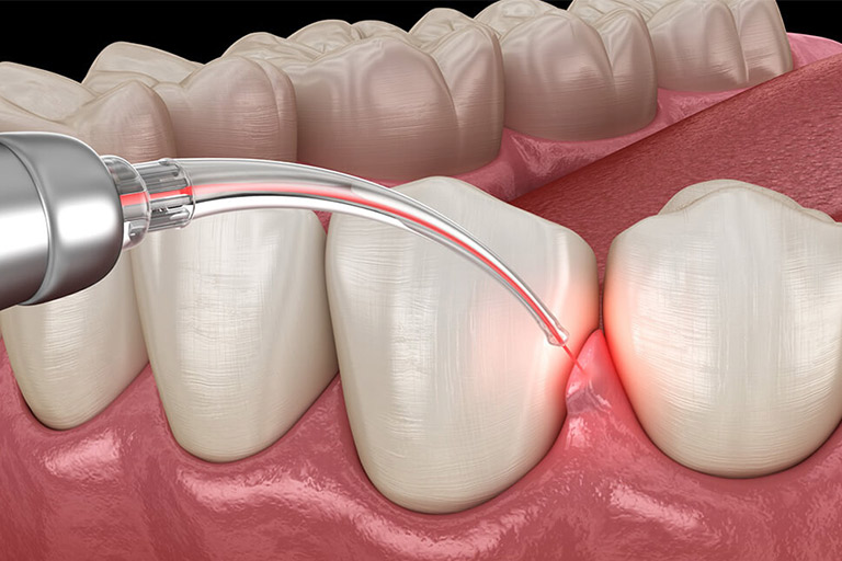 Laser dental